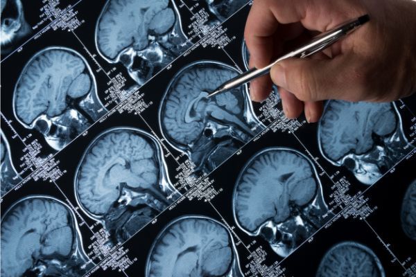 Brain scan evidence plays important role in criminal trials